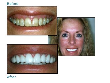 Before and after dental patient pictures