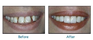 Before and after dental patient pictures