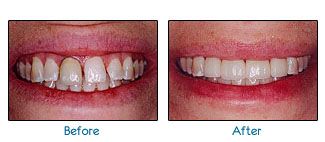 Before and after dental patient pictures
