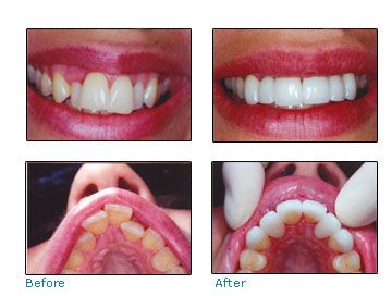 Before and after dental patient pictures