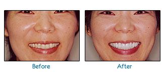 Before and after dental patient pictures