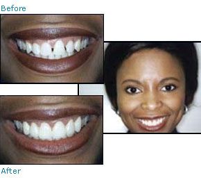 Before and after dental patient pictures
