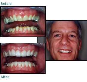 Before and after dental patient pictures