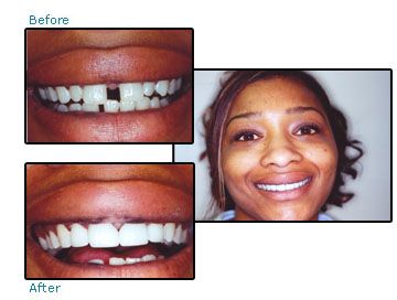 Before and after cosmetic dentistry patient