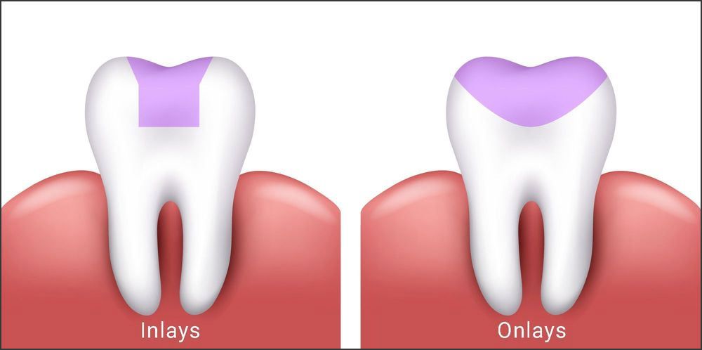 Comparison of inlay and onlay